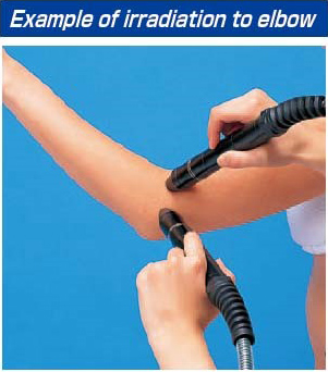 Example of irradiation to elbow